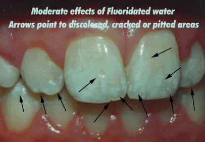 dental-fluorosis.gif