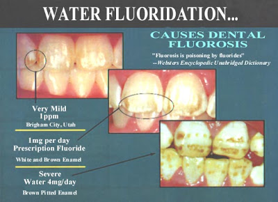 Fluorosis.jpg