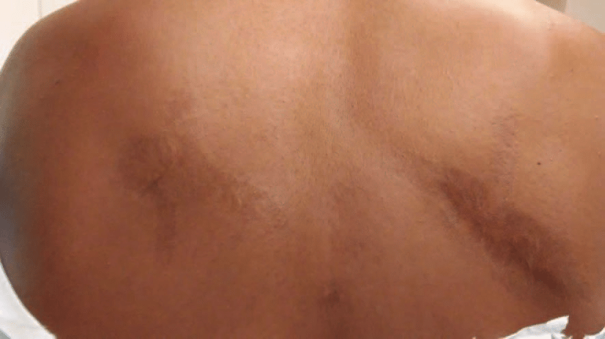 The-posterior-thorax-of-a-Somali-refugee-with-scars-resulting-from-burns-intended-to.png