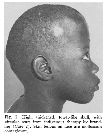 In 1962 British doctors in Uganda made note of  a number of young patients who had arrived in recent months with swollen foreheads and iron deficiency. The children were all part of the same minority group: the Bahima, close relatives of the Tutsi. 