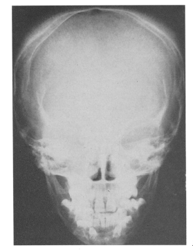 In their writings on “Elongated Africans Hiernaux and Baker didn’t even attempt to explain why desert environments would produce large foreheads in, say, Somalis. But I know of a condition induced by milk consumption which can swell the size of the forehead: the Bahima disease. 